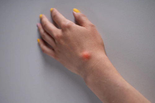 Ganglion-Cyst-Wrist-Treatment3721f3c82de78d24.jpg