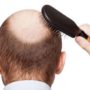 Best-Hair-Loss-Treatment-In-Mumbai-India79839f85e5ba96b8.jpg