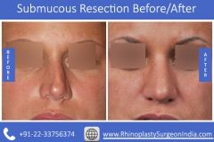 Do-you-need-Thumbs-Submucousal-Resection447424cc157fefd0.jpg