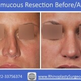 Do-you-need-Thumbs-Submucousal-Resection447424cc157fefd0