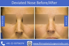 Fix-your-thumb-Deviated-nose1145b9032fff0aec.jpg