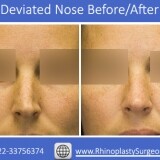 Fix-your-thumb-Deviated-nose1145b9032fff0aec