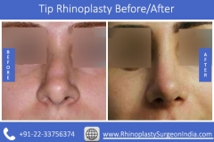 How-Thumbs-tip-Rhinoplasty-worka678ccaece413bf1.jpg