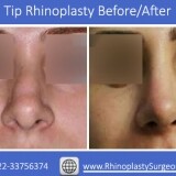 How-Thumbs-tip-Rhinoplasty-worka678ccaece413bf1