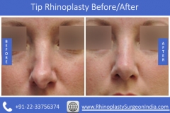 Tip-Rhinoplasty-Before-and-Afterd81867225bed5347.jpg