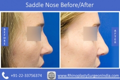 fix-your-saddle-nose-with-debrajshome2e3f85746cedc0a0.jpg