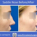 fix-your-saddle-nose-with-debrajshome2e3f85746cedc0a0