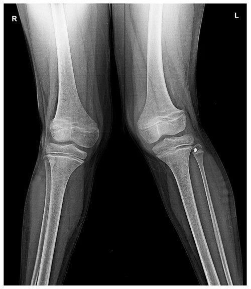 Learn more at Trishla Ortho about knock knees' causes, symptoms, diagnoses, and available treatments. They provide treatment to children of all age groups.