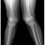 Knock-knees-Treatment-for-all-Types-of-CP-Patient-Trishla-Ortho461f8af07d1671ca