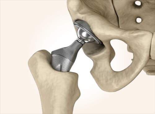Primary--Revision-Hip-Replacement-Surgery-in-Indore97868eba5a748c6a.jpg