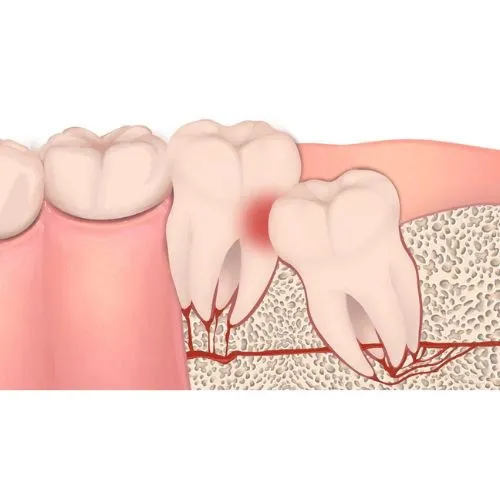 Wisdom-Teeth-Melbourne7be3cc50439de438.png